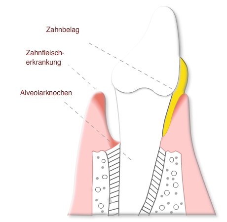 Parodontalchirurgie